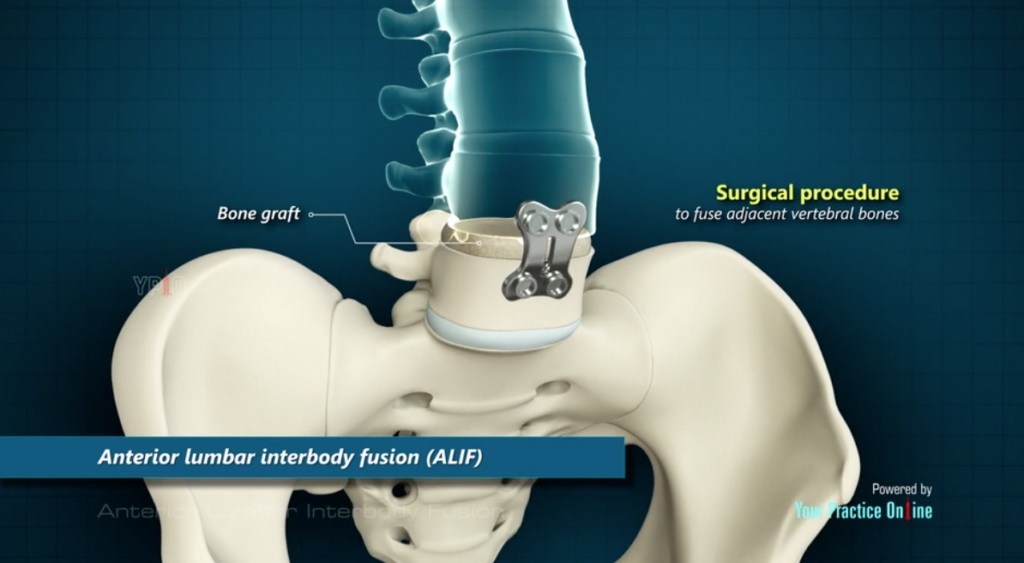 xAnterior Lumbar Interbody Fusion​