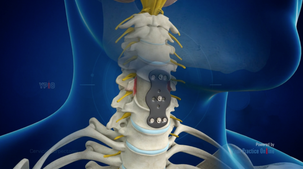Cervical Corpectomy​​